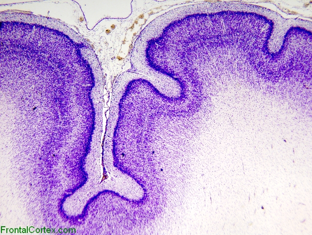 polymicrogyria cresyl violet LP